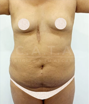 Lipoescultura antes 2