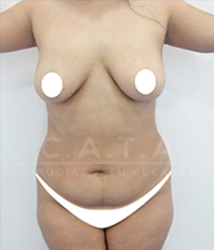 Lipoescultura antes 3