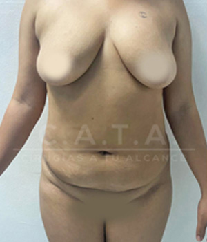 Lipoescultura antes 4