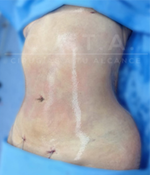 Lipoescultura despues 1