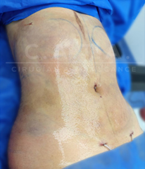 Lipoescultura despues 2