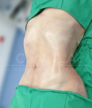 Lipoescultura despues 3